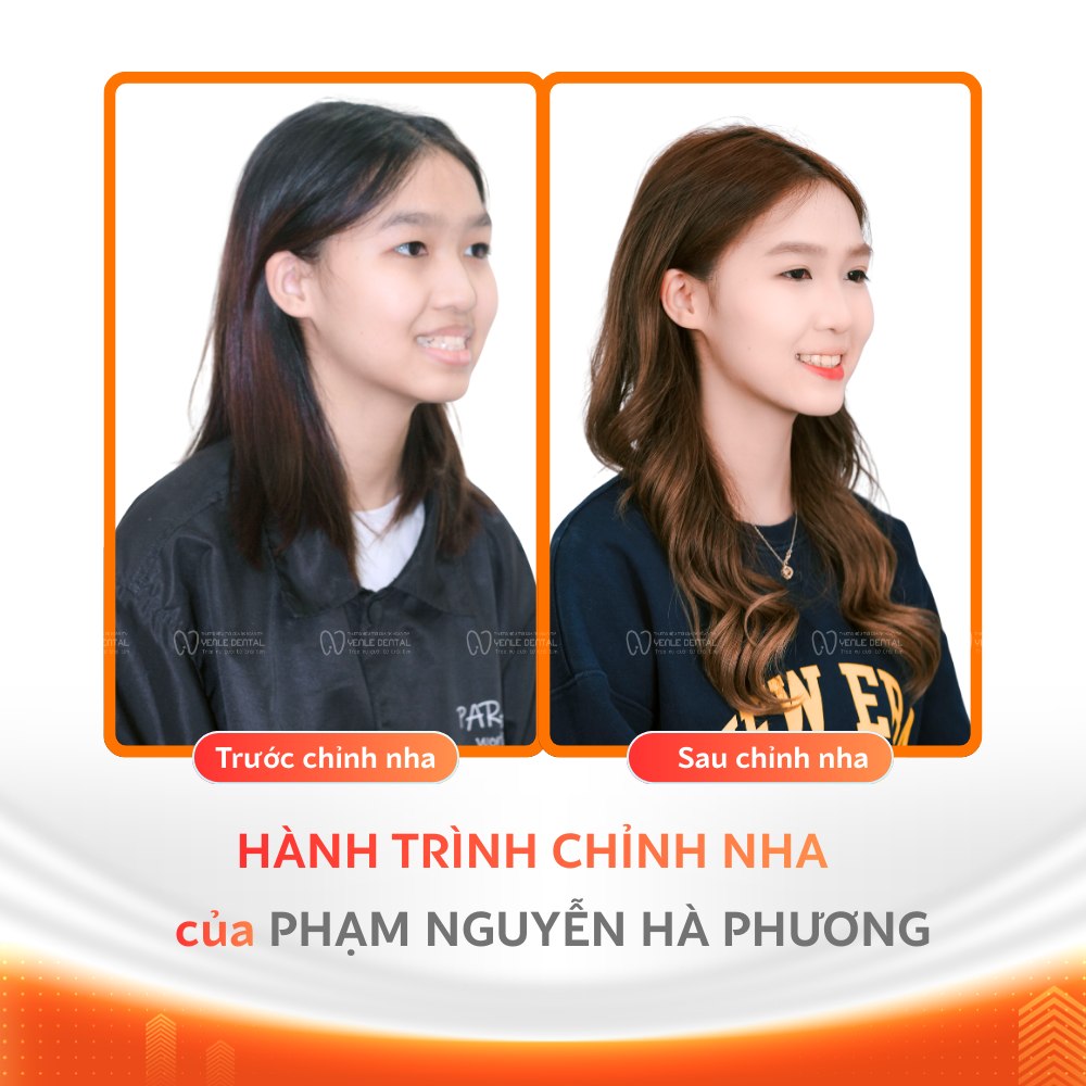 Niềng Răng Trả Góp 0% Tại Hải Phòng - Yenle Dental